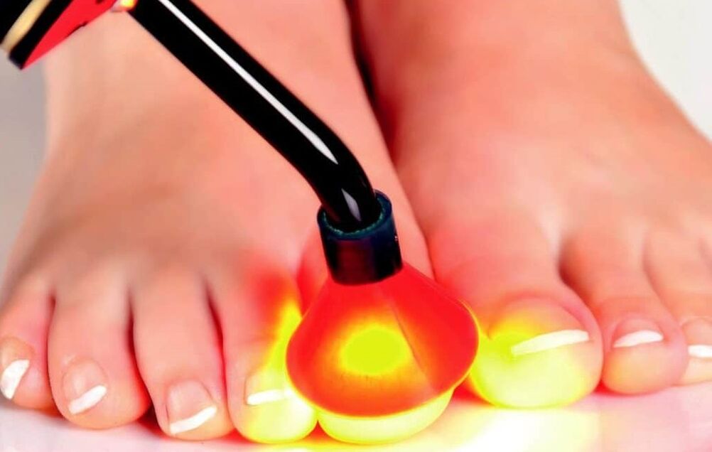 Laserbehandeling van de nagelplaat