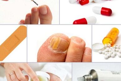 Hoe schimmel op de nagels te behandelen