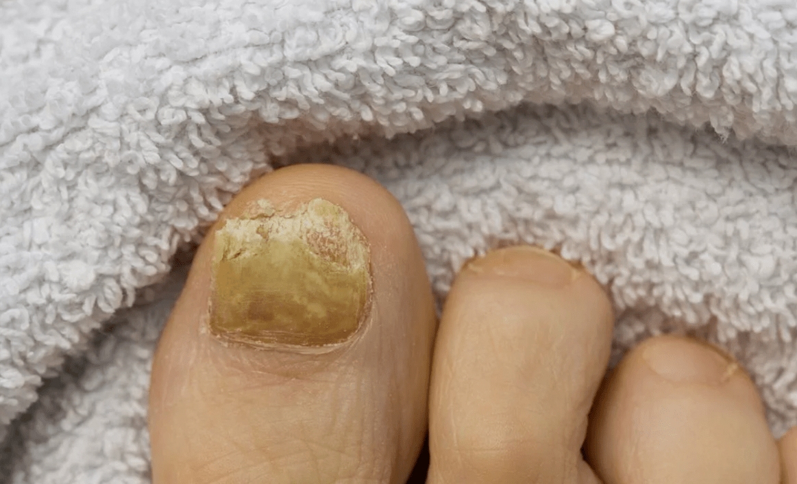 Nagelschimmel