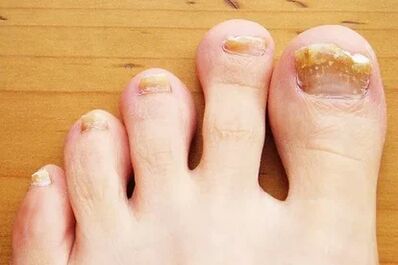 Nagelschimmel