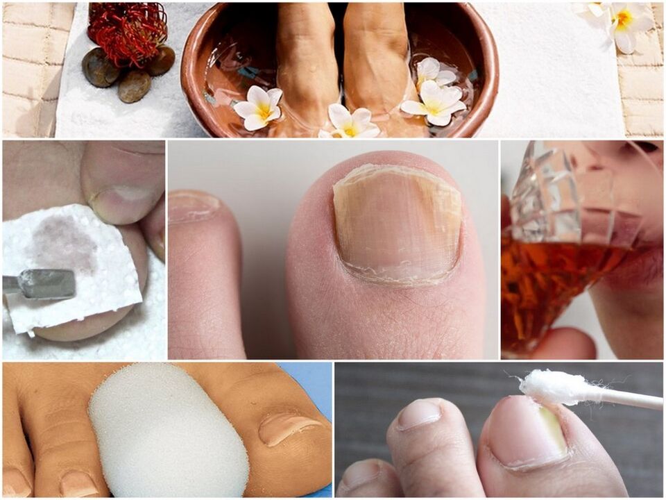 Nagelschimmelbehandeling