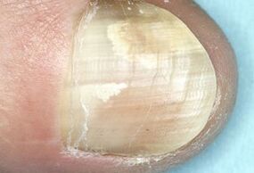 schade aan de nagelplaat als gevolg van een schimmelinfectie